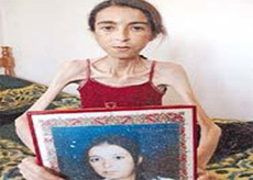 Yeme Bozukluklarının Temel Nedenleri