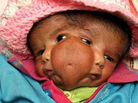 Hindistanda İki yüzlü bebek doğlu