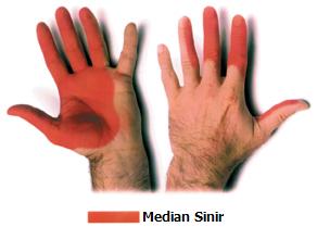 Karpal Tünel Sendromu