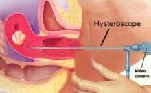 Kadınları Histeroskopi Tekniği İle Rahatlıyor
