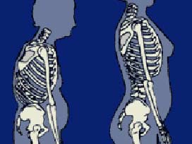 3 kadından biri osteoporoz hastası