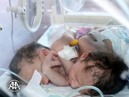 Sivas'ta Yapışık İkiz Dünyaya Geldi