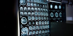 Ölen bir insanın beyin aktivitelerini ilk kez görüntüledi